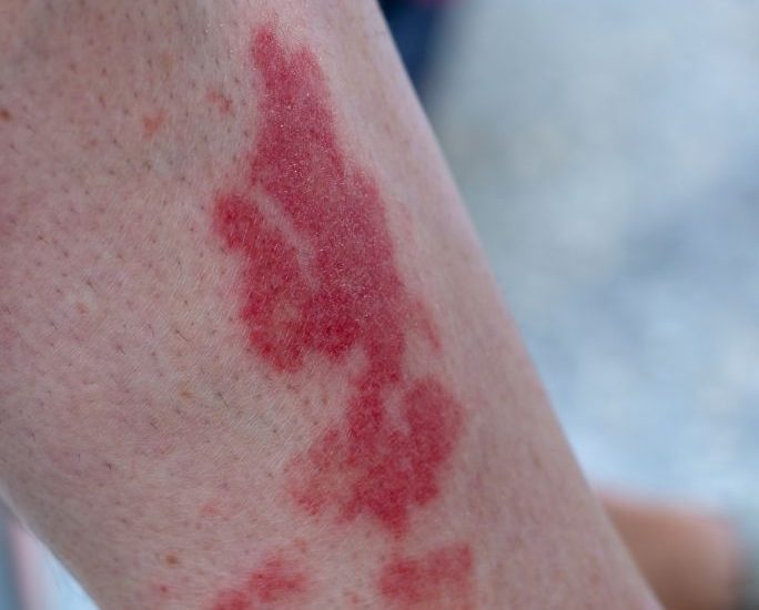 close-up view of golfer's vasculitis, or the Disney Rash, on a woman's leg